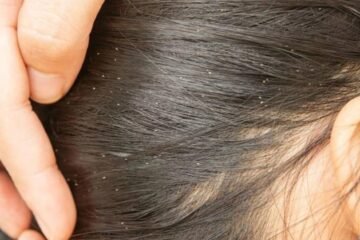 La SSM te dice cómo prevenir infestaciones de piojos en esta temporada calor